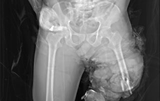 Fractures