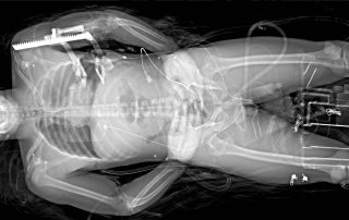 Scalpel in chest