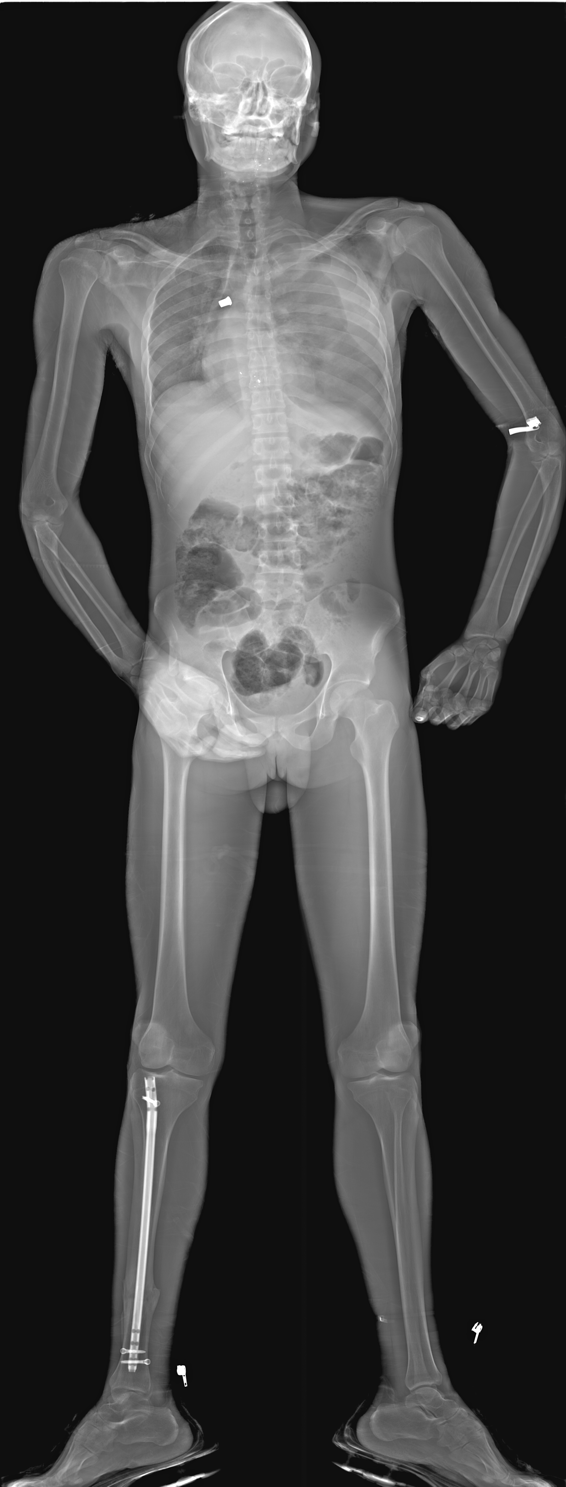 Surgical implant
