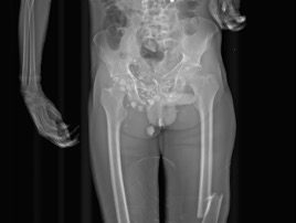 Trauma fractures + FB